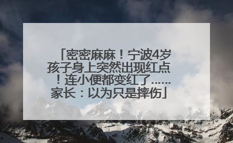 密密麻麻！宁波4岁孩子身上突然出现红点！连小便都变红了……家长：以为只是摔伤